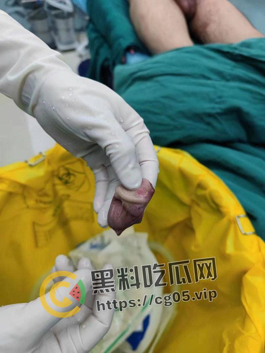 神医在世！ 鸡鸡被女友咬断都能接回去 还不影响性功能